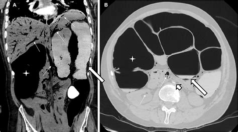 Pneumatosis intestinalis with portal, mesenteric and renal gas due to colonic pseudo-obstruction