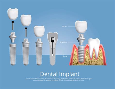 Image result for Different Types of Teeth Implants