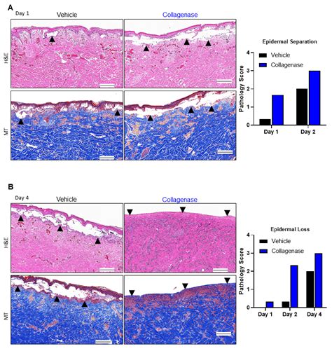 Clostridium Collagenase Impact on Zone of Stasis Stabilization and ...