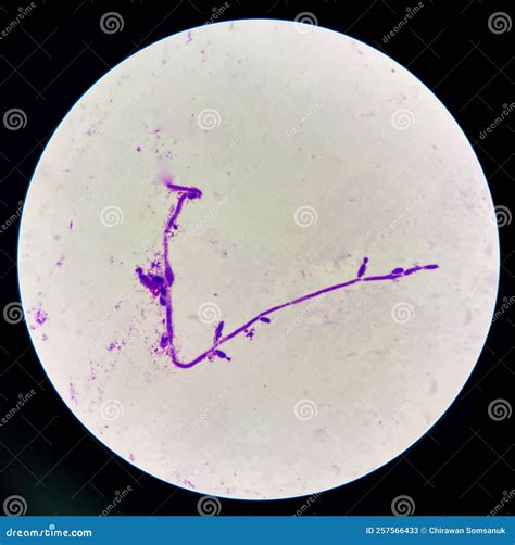 Budding Yeast Cells with Pseudohyphae in Urine Sample on Wright Gimsa ...