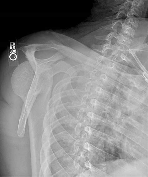 Posterior Shoulder Dislocation | Resus