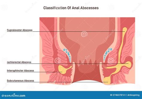Anal Abscess. Perianal Abscess, Lump Filled with Pus Found Near the ...
