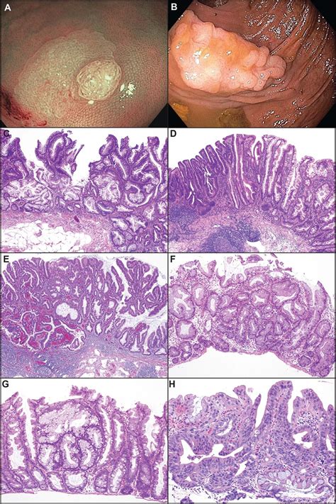 An update on the morphology and molecular pathology of serrated ...