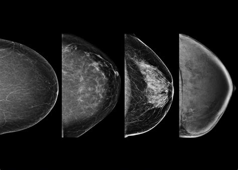 PHOTO GALLERY: What does breast cancer look like on mammography