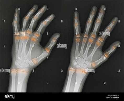 hand x-ray 12 year old male, two views with the epiphyseal growth ...