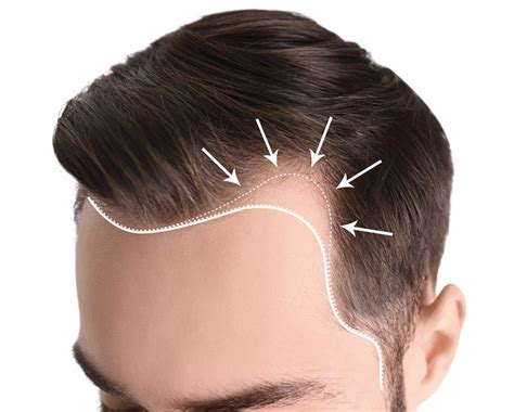 VLCC Hair Build