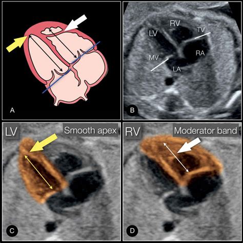 Moderator Band Ultrasound