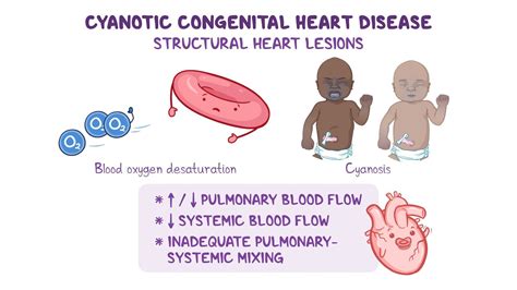 Cyanotic Congenital Heart Disease