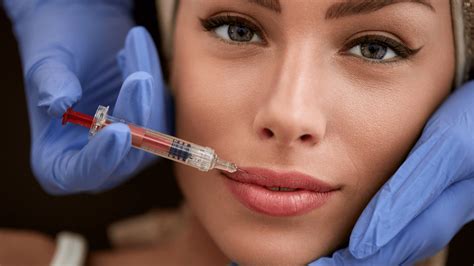 How to Tell if You Have Lip Filler Migration