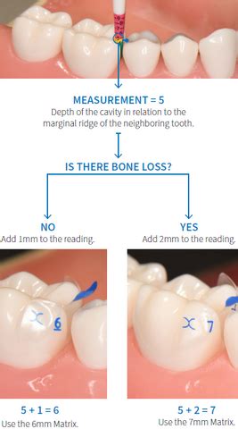 Bioclear Evolve Matrices - Anatomically Pre-Shaped Posterior Matrices ...