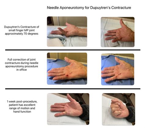 Dupuytren's Contracture Conservative Treatment at Nancy Spradlin blog