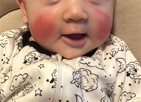 Help needed: super red cheeks at 3 months : r/newborns