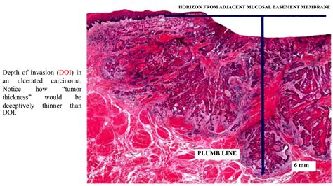 8 th edition TNM classification and significance of depth of invasion | PPTX