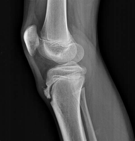 Osgood Schlatter Disease X Ray