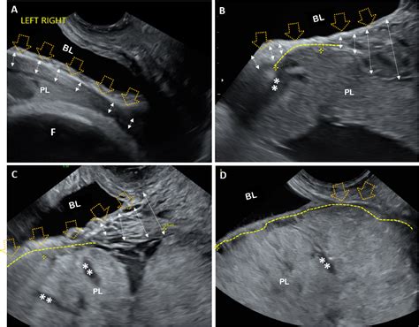 Quantifying placenta accreta spectrum severity and its associated blood loss: a novel ...