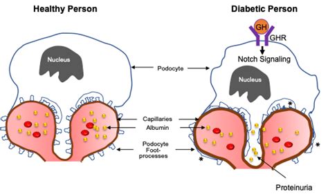 UoH biochemistry research sheds new light into diabetic kidney diseases