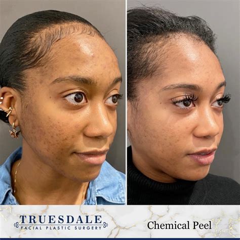 Chemical Peels Beverly Hills | Truesdale Facial Plastic Surgery