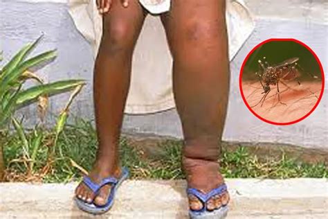 Lymphatic filariasis spreads mosquito know how to care: सावधान! मच्छर ...