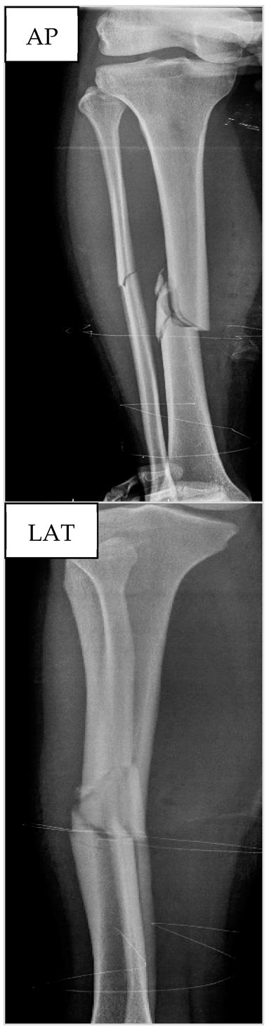 Comparison of Radiographic Outcomes Assessed via the Radiographic Union ...