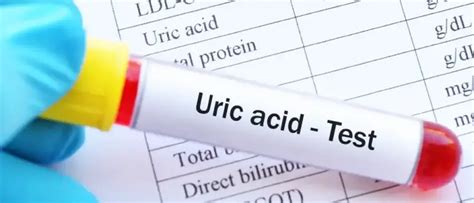 यूरिक एसिड के लक्षण और उपाय क्या है? जानें, इसका नॉर्मल रेंज