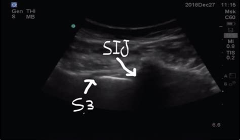 Injection Therapy 的图像结果