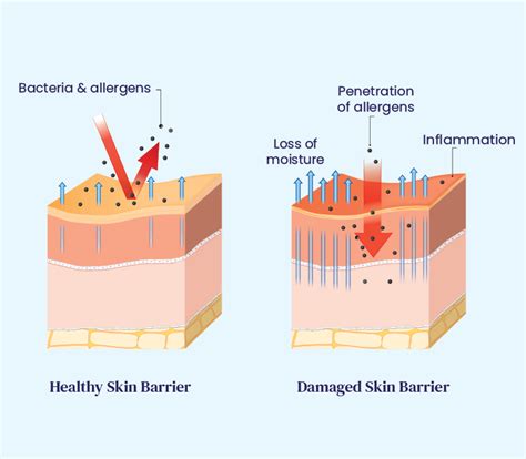 Atopic Dermatitis (Eczema) : Causes, Triggers, And Prevention Tips – Re ...