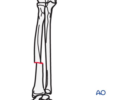 Image result for Simple Radius Fracture