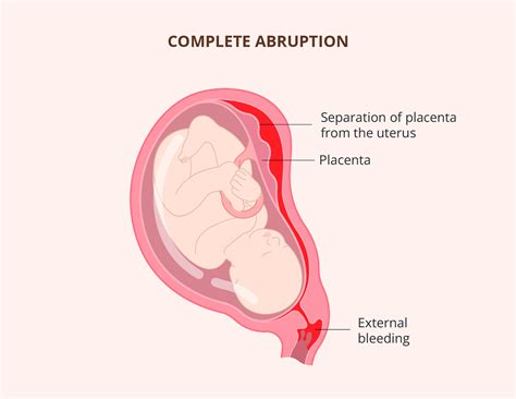 Normal Placenta Diagram
