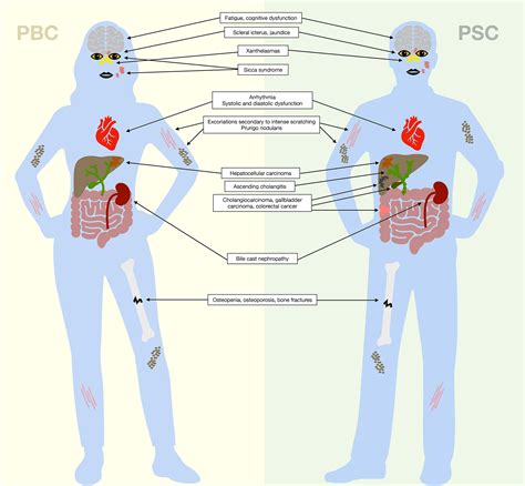 Systemic Complications of Primary Biliary Cholangitis - Clinics in ...
