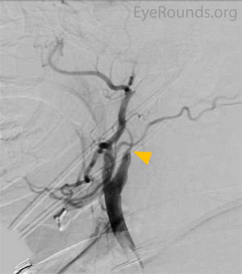 EyeRounds.org: Ocular Ischemic Syndrome