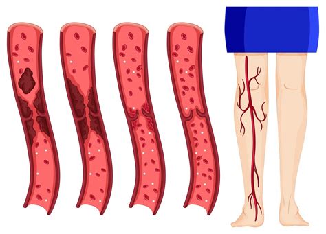 How Are Blood Clots Diagnosed? - Hamilton Vascular