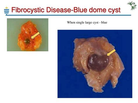 Bluedomed Cyst Fibrocystic Disease