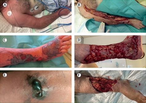 Necrotising soft-tissue infections - The Lancet Infectious Diseases
