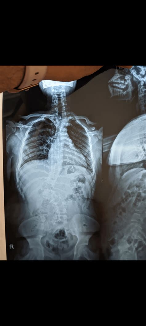 Cobb angle : r/scoliosis