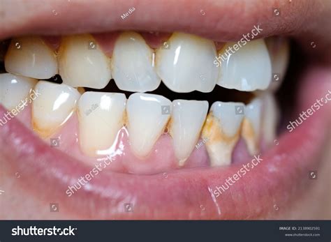 47 Decalcify Dental Images, Stock Photos & Vectors | Shutterstock