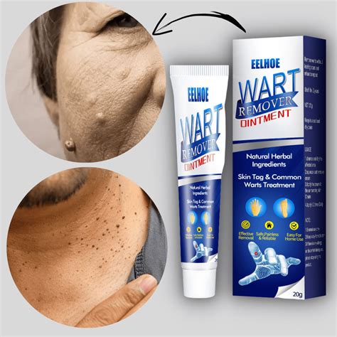 MT Instant Warts Remover Cream🌵- Doctor's No 1 Choice (Buy 1 Get 1 Fre ...