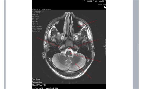Brain CT Scan 的图像结果