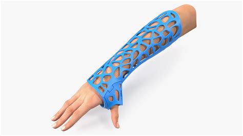 3D-Printed Orthopedic Casts on Limbs Collection 3D Model $99 - .3ds ...