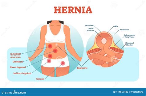 Hernia Types Vector Illustration and Cross Section of Muscle Rupture and Intestine. Stock Vector ...