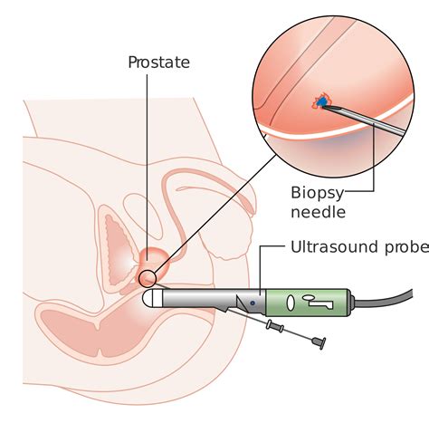 The Truth About Prostate Biopsy