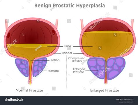 Benign Prostatic Hyperplasia Anatomy Enlarged Normal Stock Vector (Royalty Free) 2402066325 ...