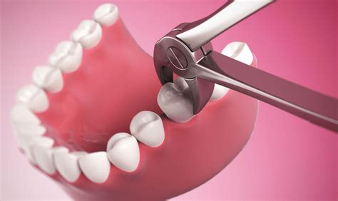 Image result for Stitches After Tooth Extraction