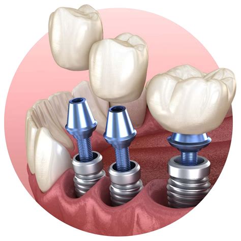 Implantología y Cirugía Maxilofacial y Oral - Clínica Odontológica Cabezas