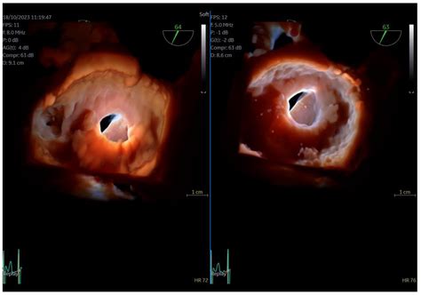 Initial Experience with the 4D Mini-TEE Probe in the Adult Population