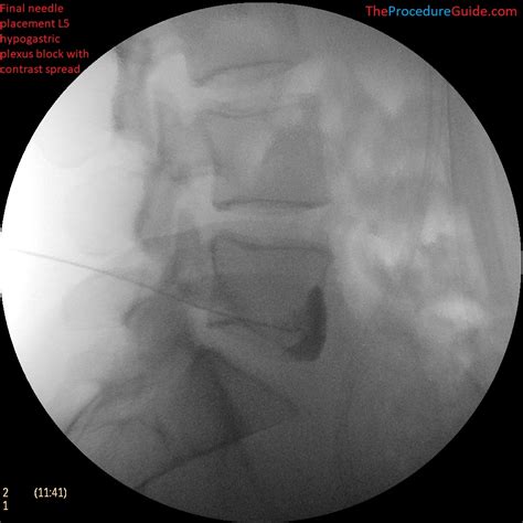 Image result for Fluoroscopy Injection