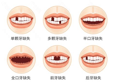 补牙和种牙有什么区别？ - 知乎