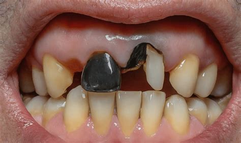 Image result for Stumpy Black Teeth