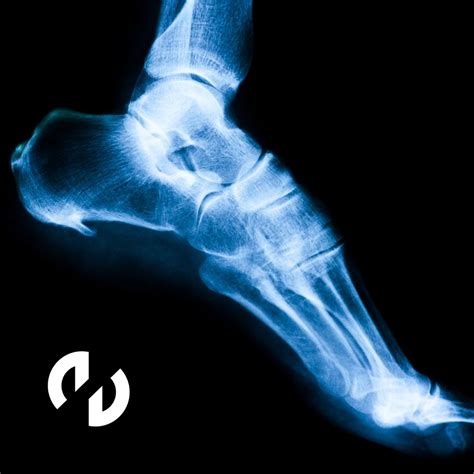 ¿Qué es el espolón calcáneo?