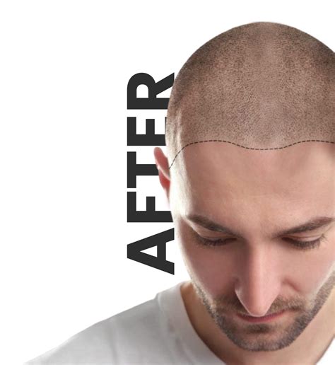 The Hair Transplant Center – New Jersey | FUE, FUT & More Hair ...