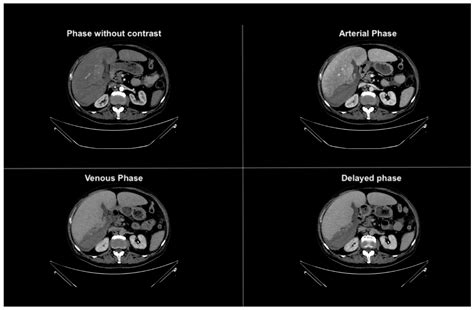 Atraumatic Hepatic Laceration with Hemoperitoneum